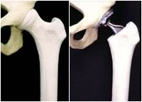 Natural and replacement hip comparison