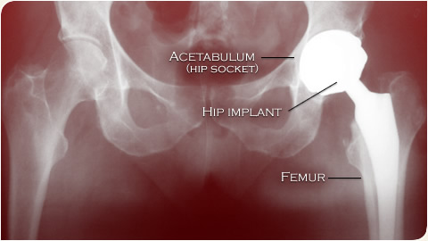 Metal on metal hip prosthesis