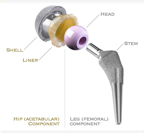 Hip Replacement Components